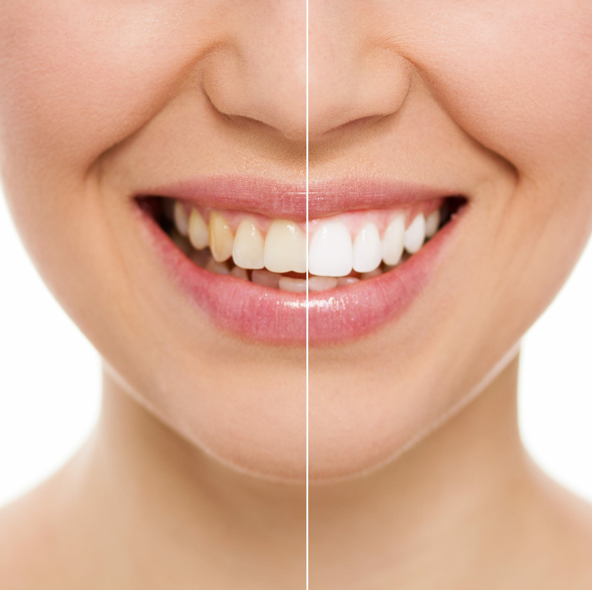 Зубы после восстановления: до и после